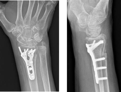 Radius Fracture 的图像结果