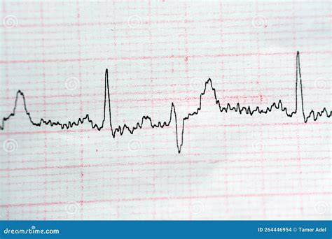 ECG ElectroCardioGraph Paper that Shows Normal Sinus Rhythm NSR with Frequent PACs Premature ...