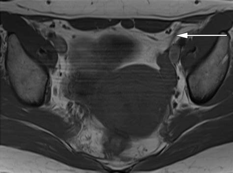 Suspensory Ligaments of the Female Genital Organs: MRI Evaluation with ...