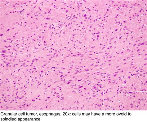 Granular Cell Tumor Larynx