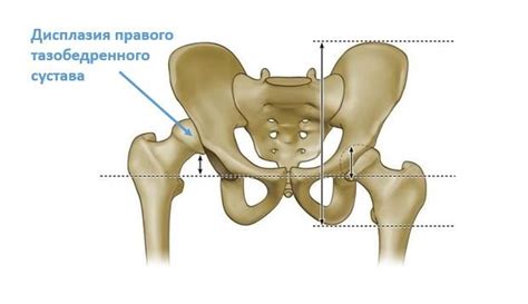 Дисплазия тазобедренного сустава у взрослых: симптомы, диагностика ...