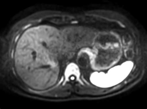 Abdomen large FOV imaging | Philips MR Body Map