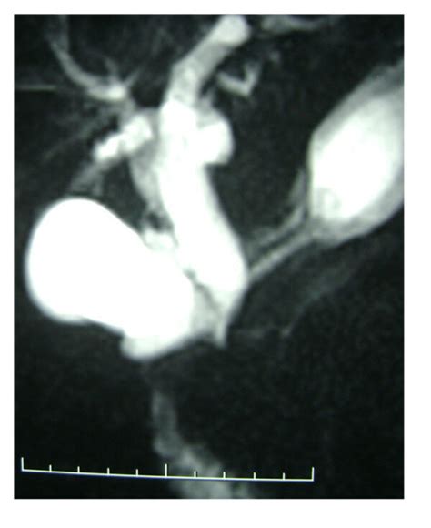 Image result for MRCP Biliary Tree
