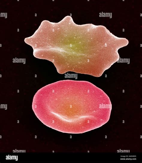 Red blood cell crenation. Coloured scanning electron micrograph (SEM ...