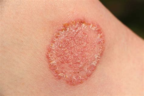 How To Treat Jock Itch or Khujli?
