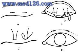双重睑手术操作步骤,图片图谱图解,手术治疗方法,诊断眼部成形术