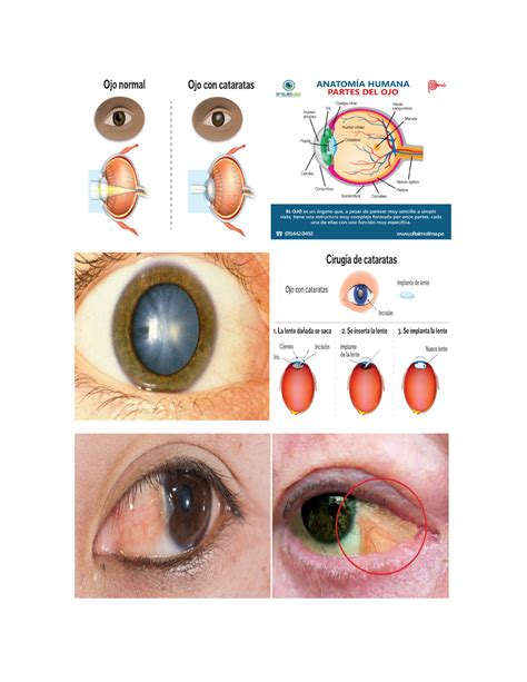 ENF. DE LOS OJOS - enfermedades de los ojos - Enfermería medica - Studocu
