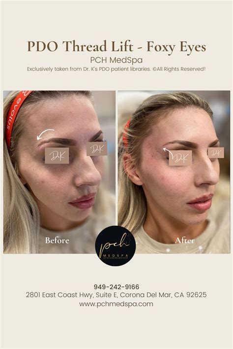 Image result for Thread Lifting Face