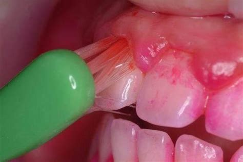 我的牙龈为什么总是出血？究竟是由哪些原因造成的？ - 贝色口腔