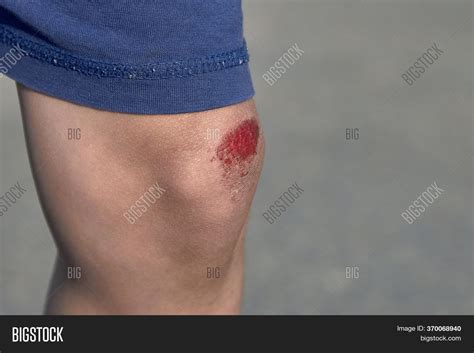 Bruised Wound On Knee Image & Photo (Free Trial) | Bigstock