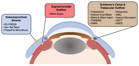 Minimally Invasive Glaucoma Surgery: A Review of the Literature