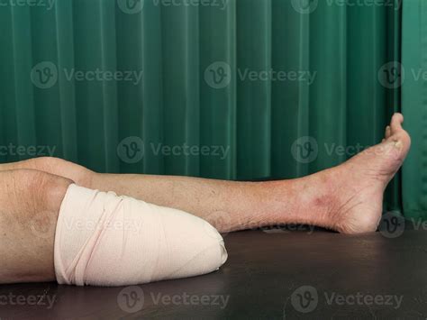 Below knee amputation bandaging for BK prosthesis. 12606289 Stock Photo at Vecteezy