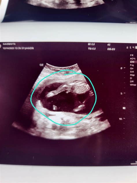 16 week ultrasound! Everyone says girl, but NIPT & ultrasound tech said ...