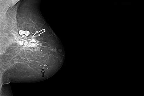 Fat Necrosis Breast Reduction Fat Necrosis: Complication Of Cosmetic