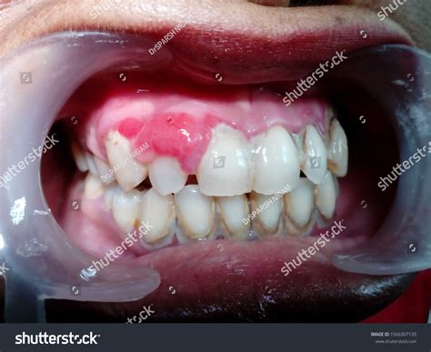Gum Infection