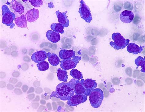 Plasma cell leukaemia, Multiple Myeloma progression