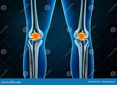 Kneecap Bone
