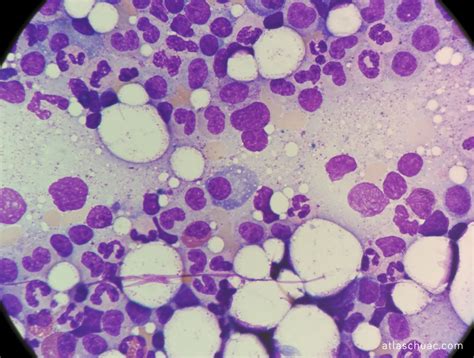 Leucemia aguda linfoblástica – LaboATLAS