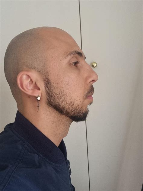 Recessed chin, mouth breather : r/orthotropics