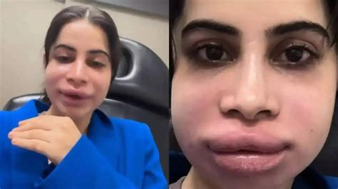 లిప్ ఫిల్లర్ అంటే ఏంటి,ఉబ్బిన పెదాలు, ముఖంతో షాకింగ్ లుక్‌లో ఉర్ఫీ ...