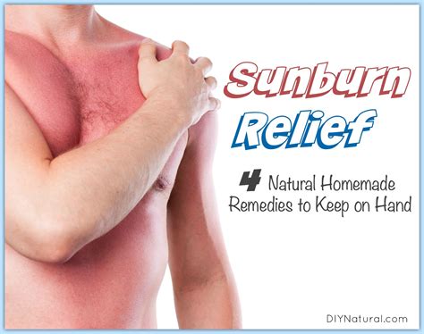 Sunburn Relief: Four Natural Sunburn Remedies At Home
