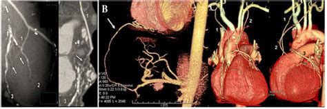 Radial Artery Used as Conduit for Coronary Artery Bypass Grafting