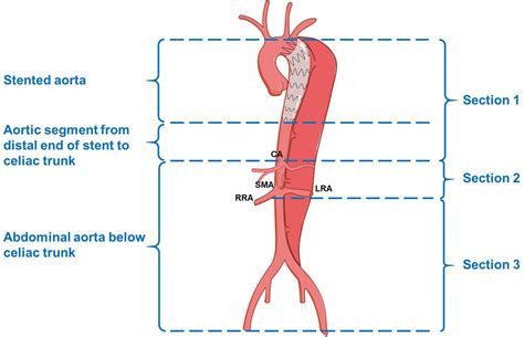 Frontiers | Long-Term Aortic Remodeling After Thoracic Endovascular Aortic Repair of Acute ...