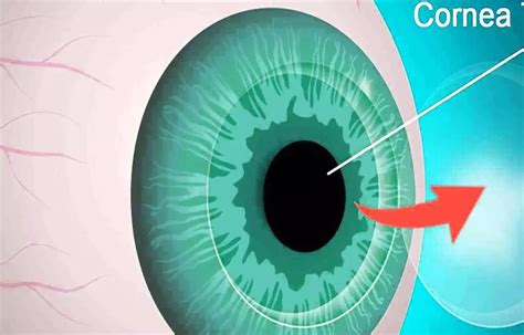 Case of Cutaneous Melanoma presenting with Pigmented Corneal Mass ...