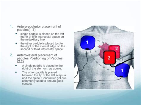 Image result for Cardioversion Steps