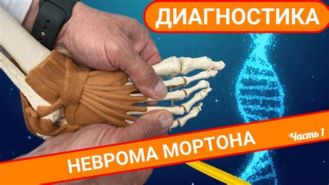 Неврома Мортона - лечение, симптомы, профилактика заболевания