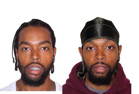 Triple jaw surgery 4 — Elite Oral and Facial Surgery- Long Island Oral and Maxillofacial Surgeon