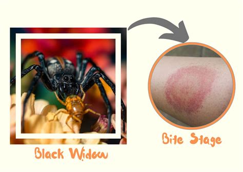 Black Widow Spider Bite Stages, Symptoms with Pictures (Identification)