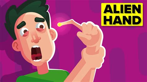 Image result for Alien Arm Syndrome