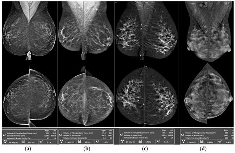 Mammographic Breast Density and Urbanization: Interactions with BMI, Environmental, Lifestyle ...