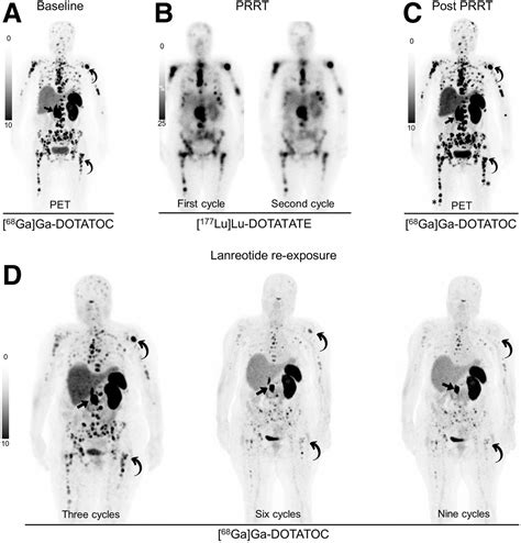 [177Lu]Lu-DOTATATE May Resensitize Neuroendocrine Tumors to Hormonal Therapy: Initial Clinical ...