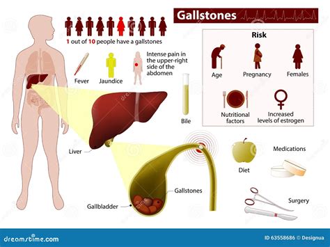Gallstones In Spanish