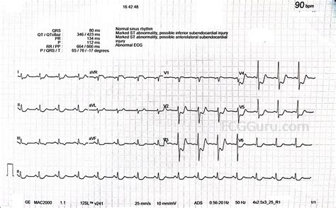 ST depression | ECG Guru - Instructor Resources