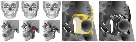 Extended Complex Temporomandibular Joint Reconstructions Exploiting ...