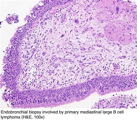 Pathology Outlines - Primary mediastinal large B cell lymphoma (PMBCL)