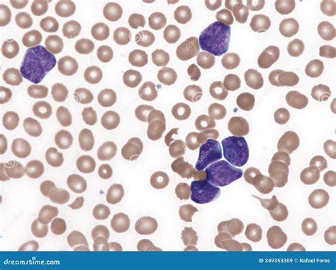 T-cell Acute Lymphoid Leukemia. Peripheral Blood. Stock Image - Image of tcell, undefined: 349353309