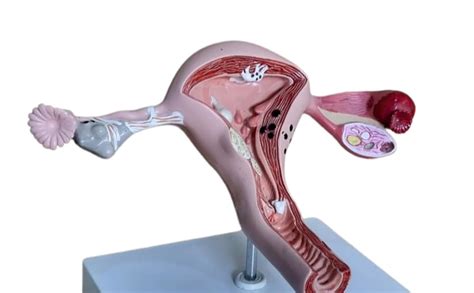 GD ANATOMICALS ® Pathological Uterus Anatomical Model : Amazon.in ...