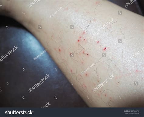 Red Spot On Leg Scratching Itching Stock Photo 1227800056 | Shutterstock