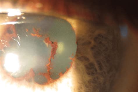 Anterior Synechiae
