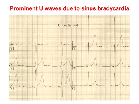 U WAVE IN ECG AND ITS ABNORMALITIES IN ECG | PPTX