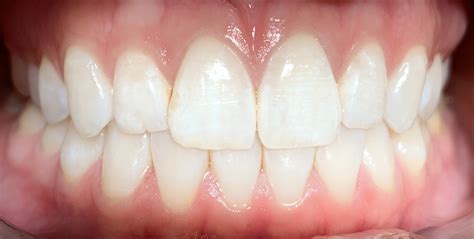 Pictures Of Healthy Gums