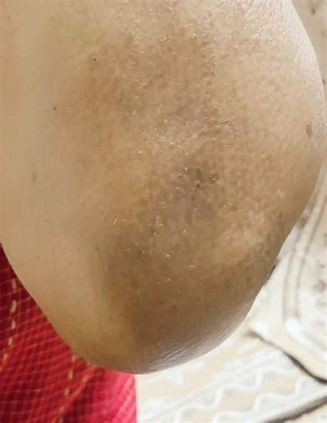 Dark Underarm Spray with Glycolic Acid | Underarm Pigmentation Spray ...