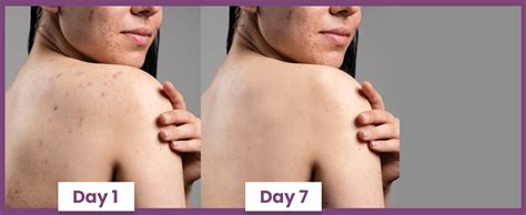 Buy Glamveda Anti Acne 1% ww Glycolic Acid & 1% ww Salicylic Acid Soap ...