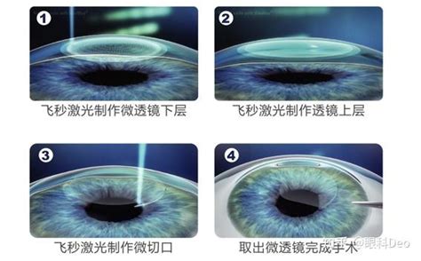 郑州全飞秒与半飞秒怎么选？盲选不行，保姆级教程辨区别 - 知乎