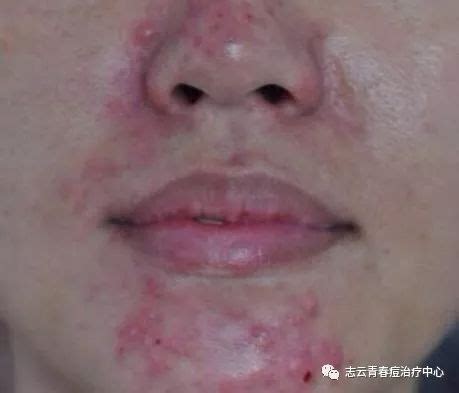 上嘴唇长胡子的位置长出许多痘痘， 这是怎么回事 用什么可以消除掉_百度知道