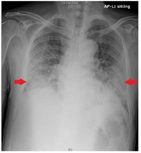 Effectiveness of Mesenchymal Stem Cell Therapy for COVID-19-Induced ...